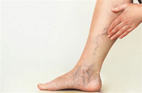 can venous leak be cured naturally|Alternative Treatments 